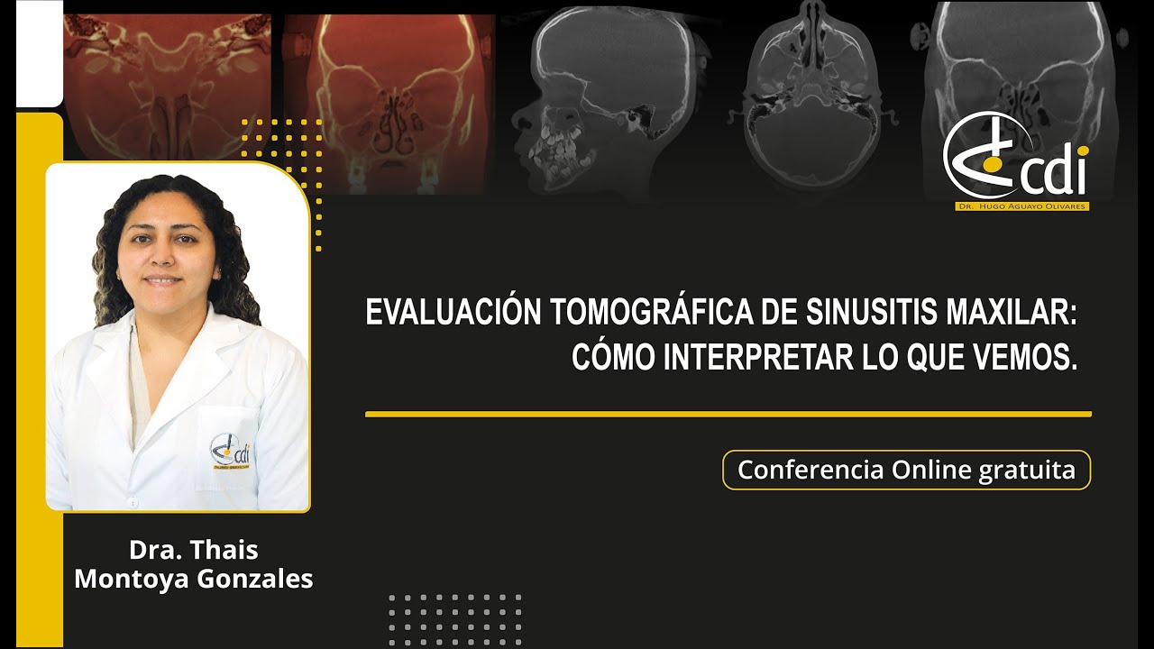 EVALUACIÓN TOMOGRÁFICA DE SINUSITIS MAXILAR: CÓMO INTERPRETAR LO QUE VEMOS.
