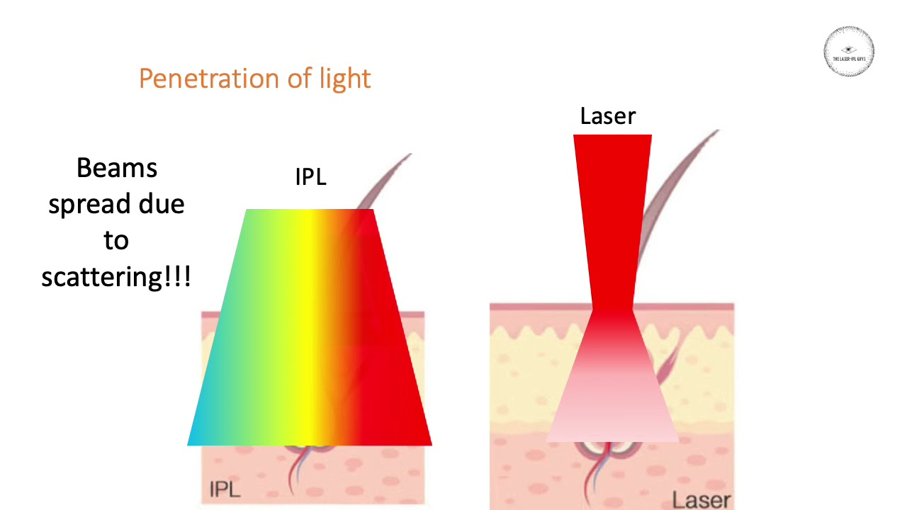 Difference between laser and IPL hair removal