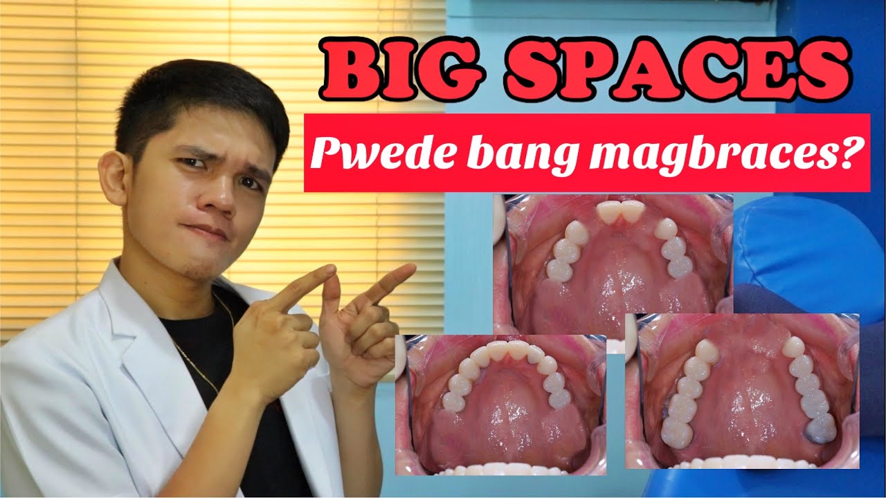 MALAKING SPACES, Pwede pang ibraces?