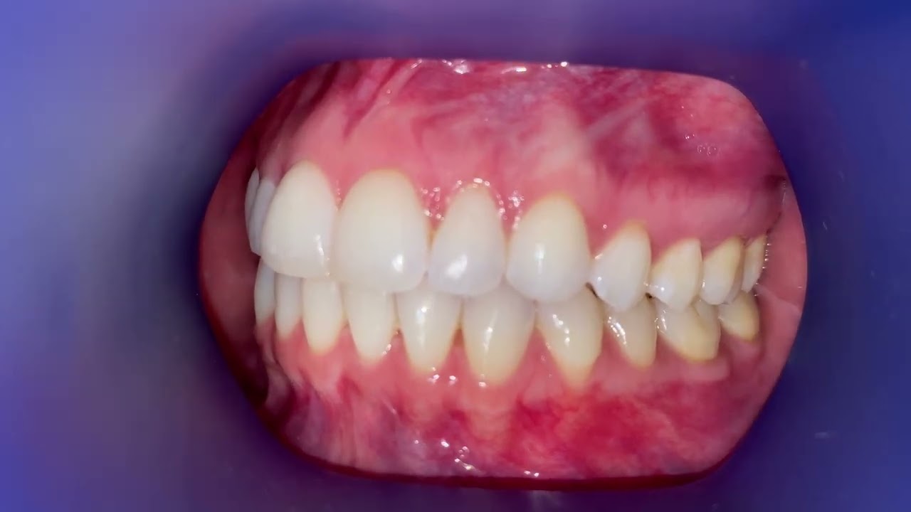How to Scan Your Teeth w/ Grin Virtual Monitoring  | Orthodontist for Teens and Adults | Irvine, CA