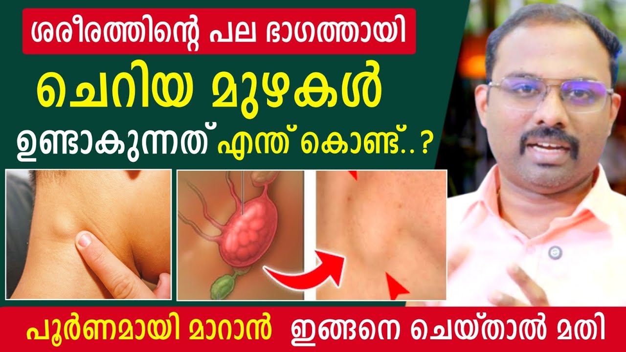 മുഴകൾ പോലെ ശരീരത്തിൽ ഉണ്ടാകുന്നത് എന്തുകൊണ്ട് ? എങ്ങനെ പൂർണമായി മാറ്റം ? Dr Visakh Kadakkal 