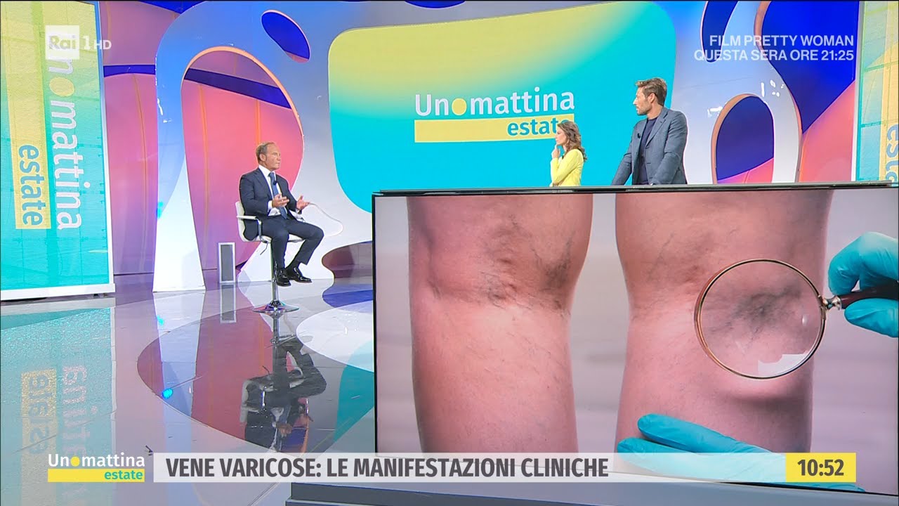 Vene varicose: i consigli per l'estate - Unomattina Estate 04/07/2022