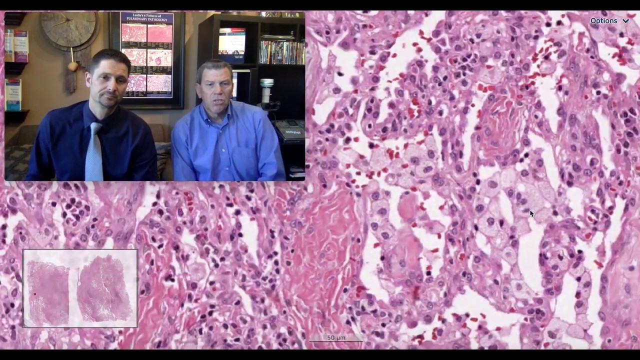 Pattern 4 - Fibrosing Organizing Pneumonia