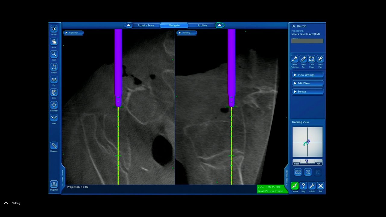 The Benefits of Using Image Guidance in Deformity Surgery - Shane Burch, MD