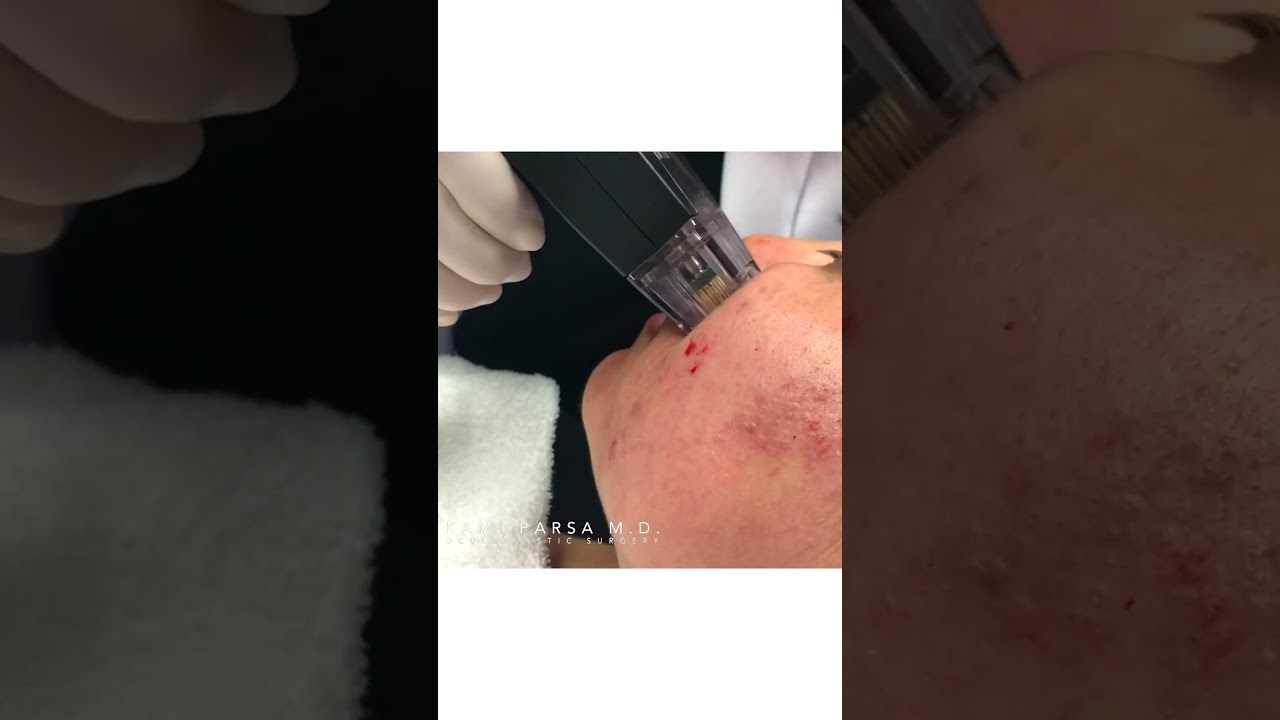 Before and After Morpheus8 for Acne | Dr.  Kami Parsa, M.D.