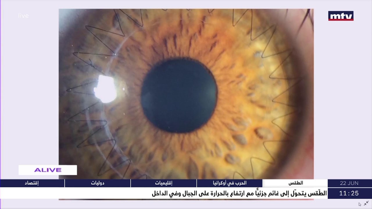 Sante – تقوس القرنية