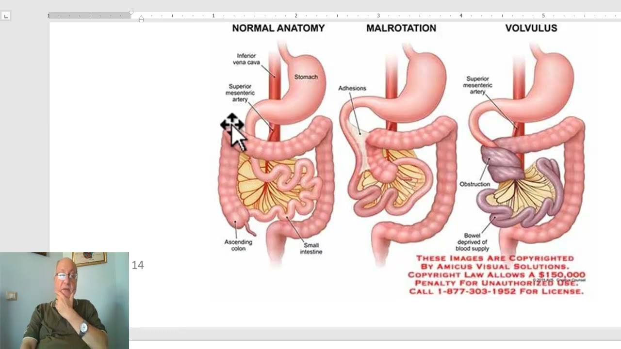 Paediatric surgery in Arabic  7 ( Disorders of Intestinal Rotation) ,  by Dr, Wahdan