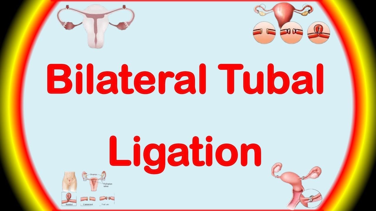 Bilateral Tubal Ligation | Permanent Birth Control Method | Family Planning