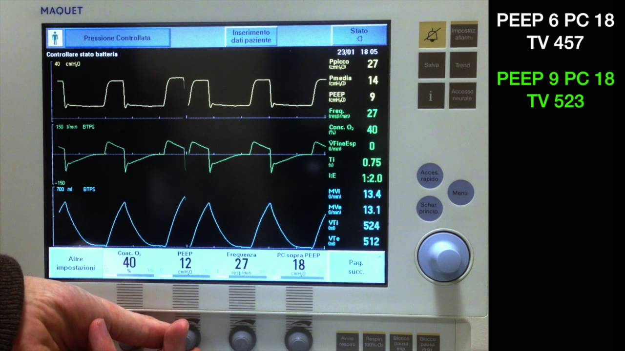 Physiological response to PEEP change during pressure controlled ventilation on a Maquet Servo-i