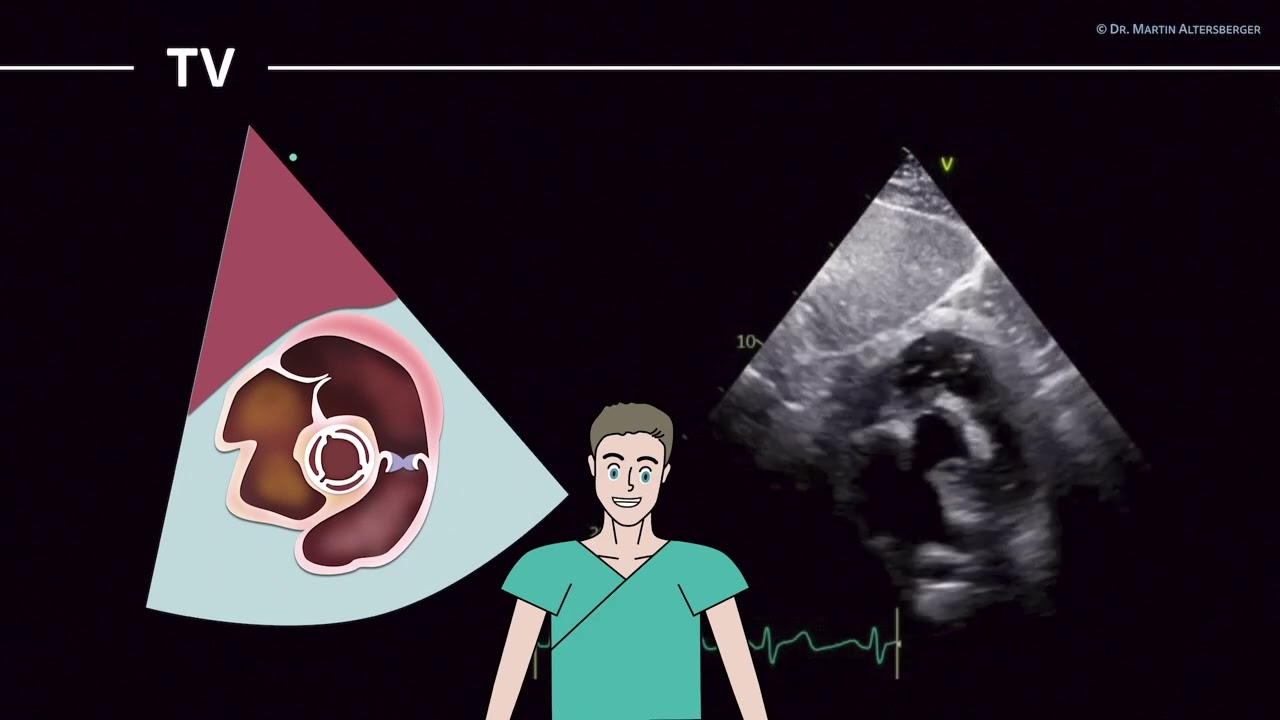 〖Echocardiography〗 Tricuspid valve, right ventricular inflow/outflow - subcostal part V