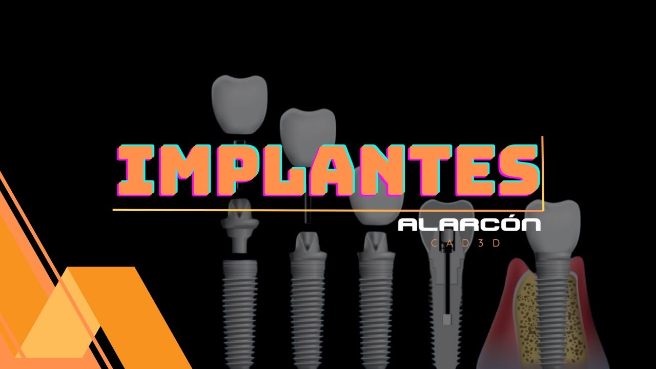 03- COMO INSTALAR BIBLIOTECA DE IMPLANTES #fluxodigital #exocad #cad #laboratoriodental
