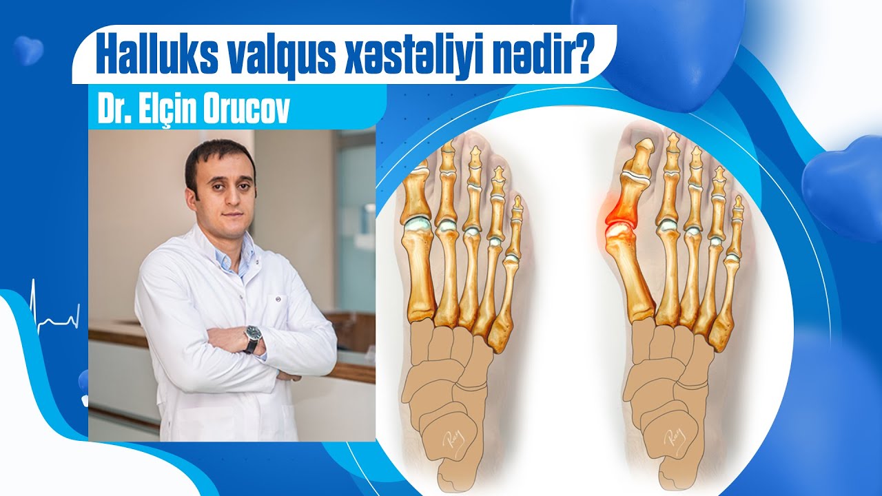 Halluks valqus xəstəliyi nədir?
