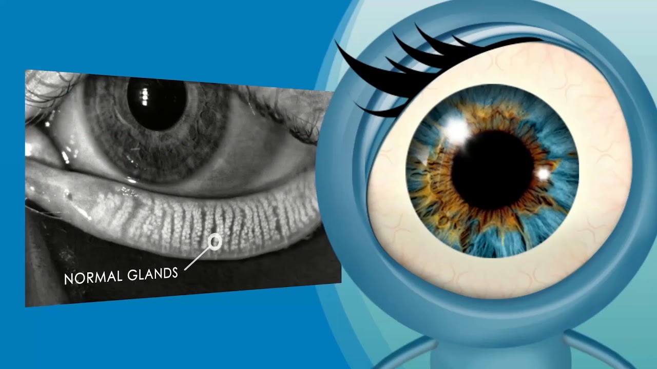 Kelly Vision Center Lipiflow treatment