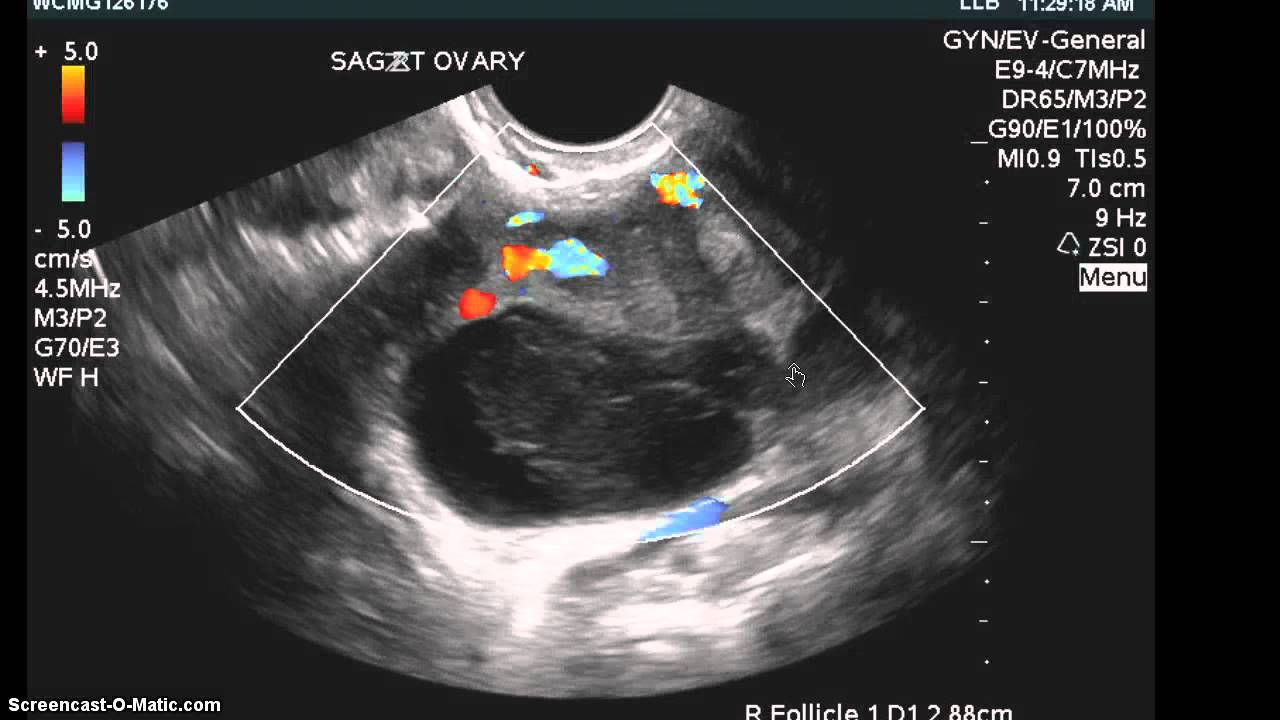 Hemorrhagic cyst and endometrioma same ovary