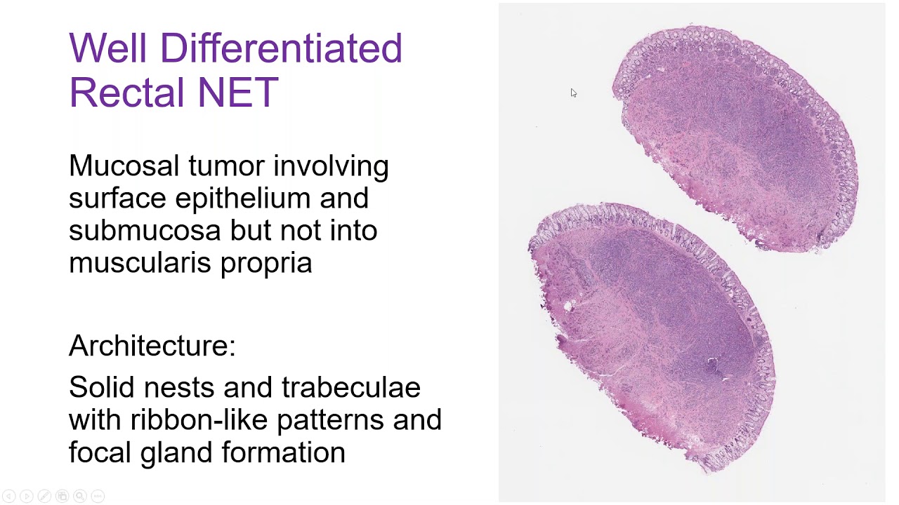 All You Need To Know About Rectal NETs