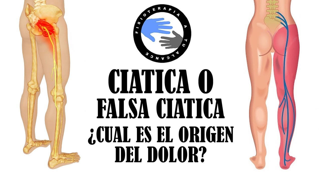 Ciatica o falsa ciatica, como diferenciar el sindrome del piramidal de una hernia