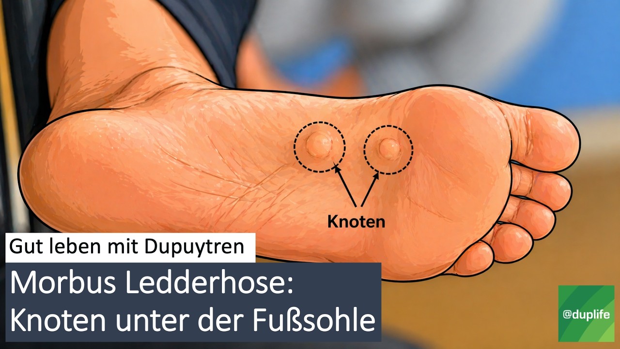 Morbus Ledderhose, das Pendant zu☝️ Morbus Dupuytren am 🦶Fuß #gutlebenmitdupuytren