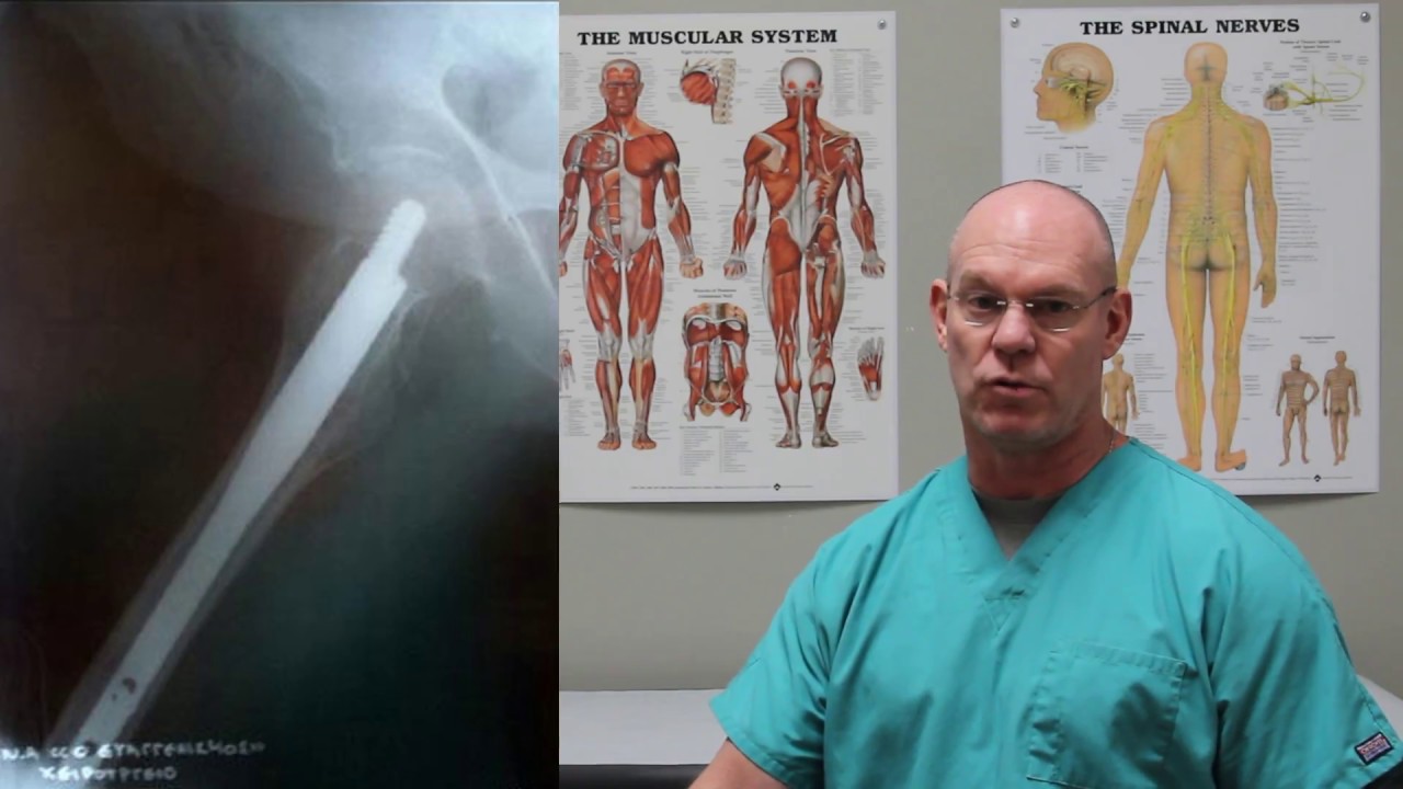 Intertrochanteric Hip Fracture | Fracture Friday Episode 36