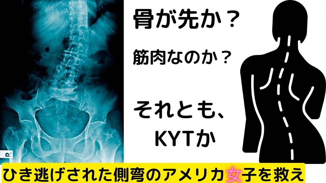 アメリカ女子【ひき逃げ】される。くの字側弯は治るのか？KYTで真っ直ぐに