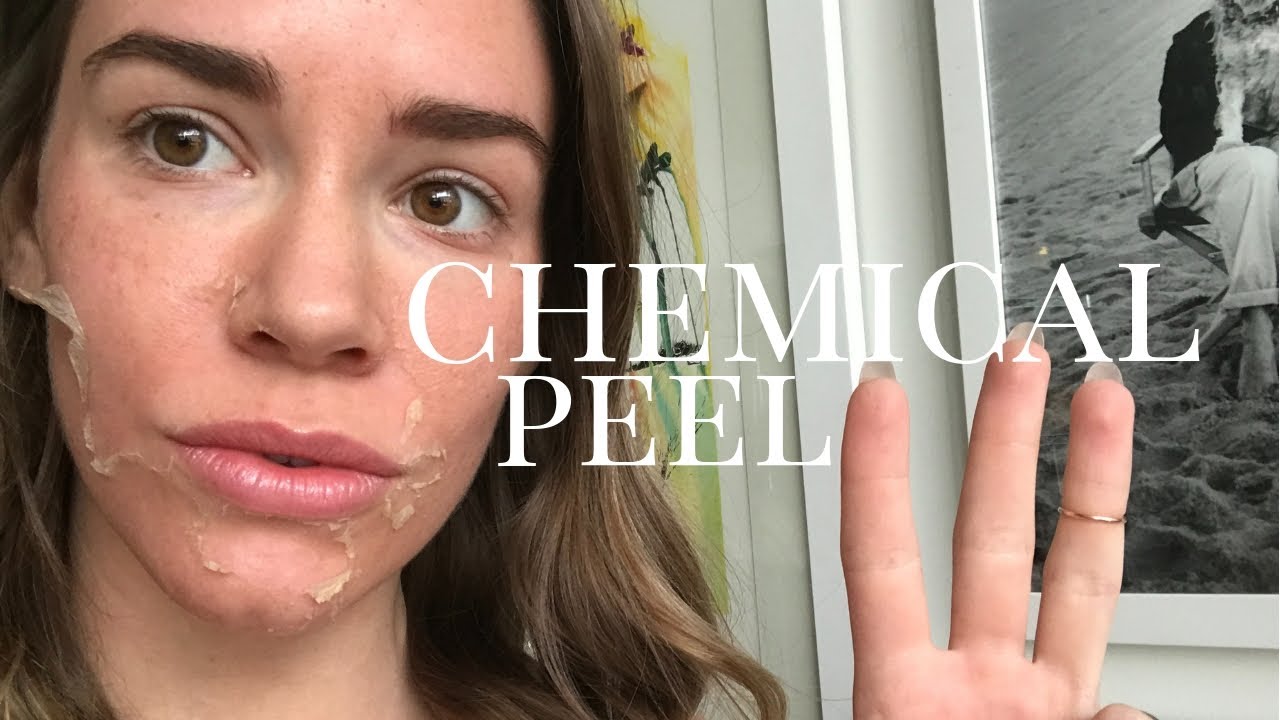 CHEMICAL PEEL before, during, and after @ Queen Bee Salon & Spa | Christa Belle