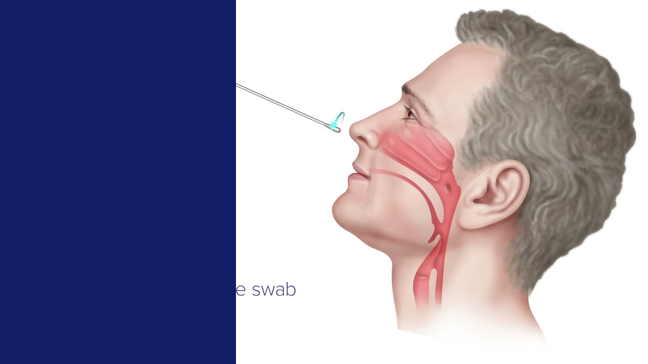 SARS-CoV-2 Clinician Collected Nasopharyngeal Specimen Collection Guide