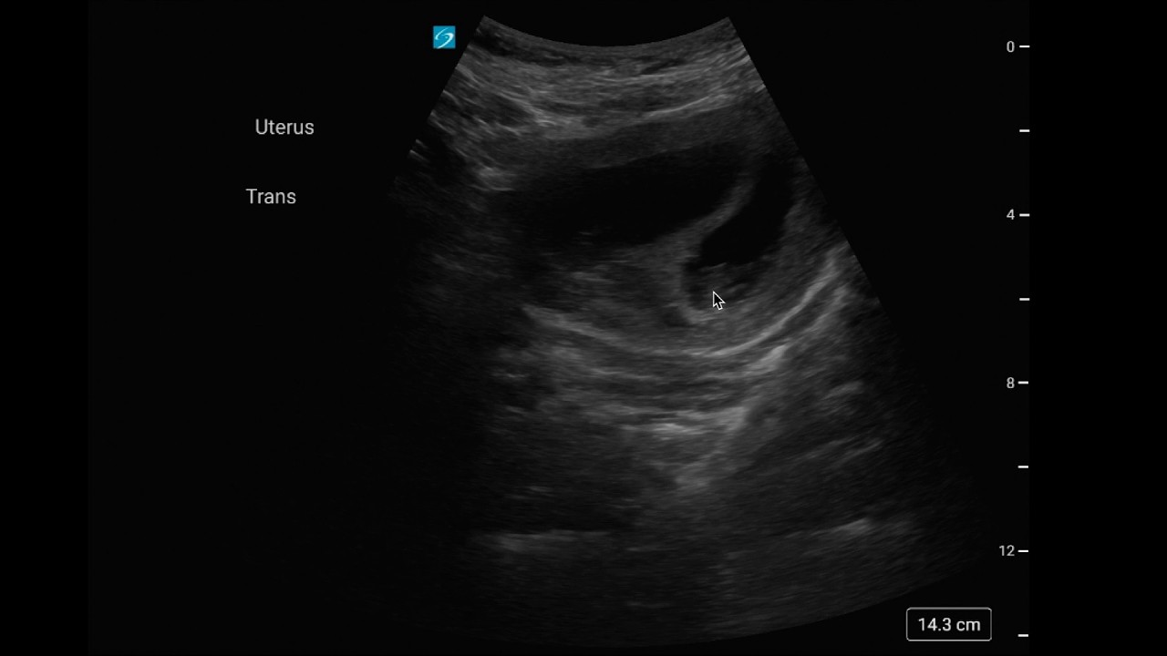 Severe Morning Sickness… or Twins? First Trimester POCUS Pearls