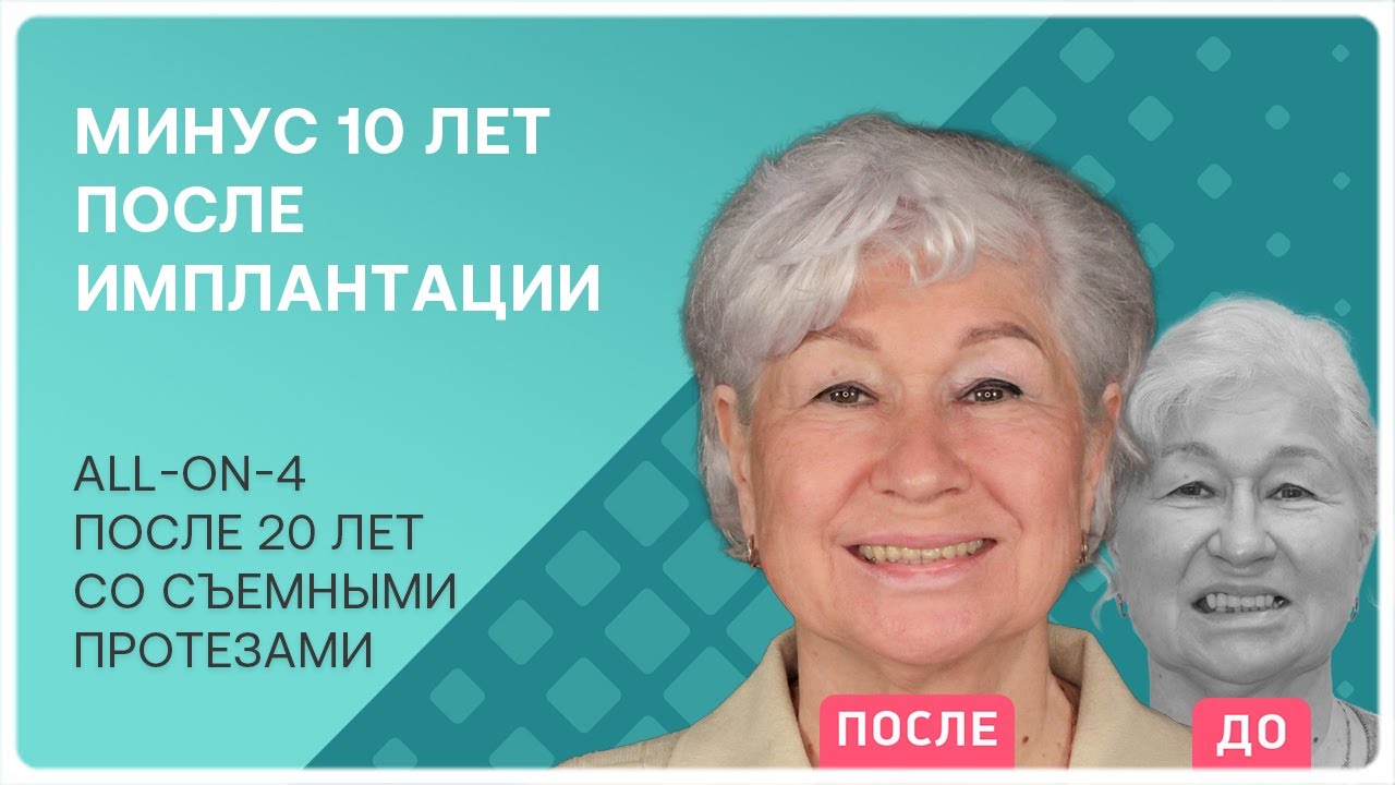 Все зубы all-on-4 на нижней челюсти 👉 реальный опыт и отзыв пациента