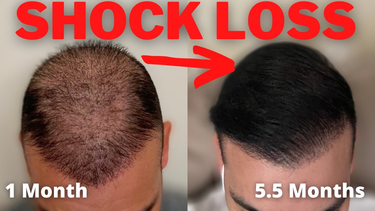 Shock Loss After A Hair Transplant  Everything You Need To Know