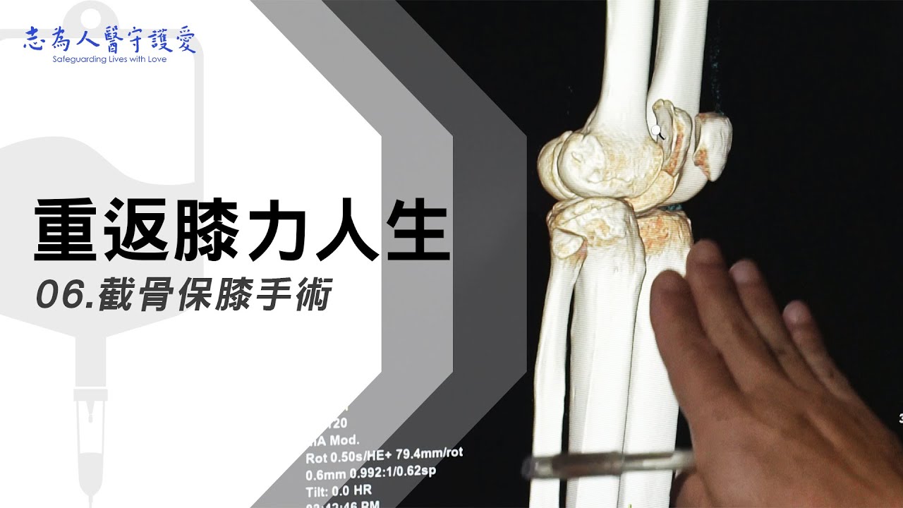 截骨保膝手術｜重返膝力人生 06｜【志為人醫守護愛】｜20230826｜Season.1人的故事