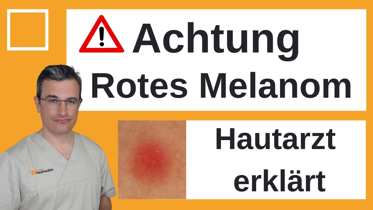 Achtung: Rotes Melanom, schwer zu erkennen. Hautarzt erkl&auml;rt | Dr. Kasten Hautmedizin in Mainz