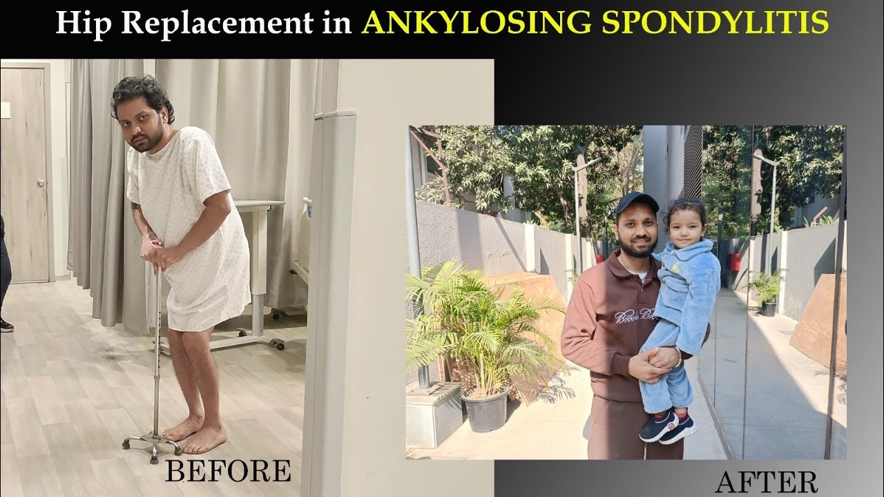 Hip Replacement in Ankylosing Spondylitis