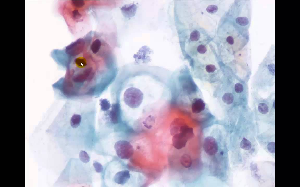 6  Citología de las Lesiones intraepiteliales escamosas del cuello uterino (LSIL; HSIL).