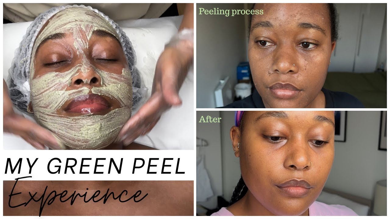 HERBAL GREEN PEEL SKINCARE TREATMENT - PROS, CONS, FINAL RESULTS!