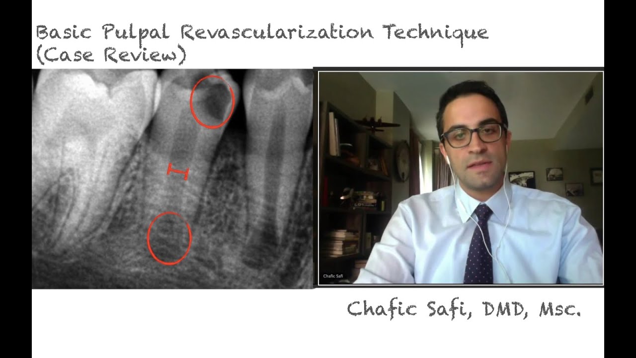Basic Pulpal Revascularization Case Review with Dr. Chafic Safi