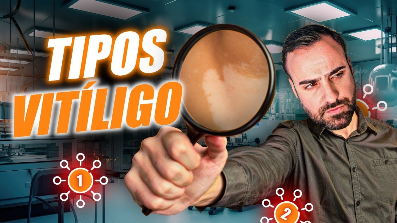 🔎 ¿Qué tipo de VITILIGO Tengo? | Cómo Averiguarlo