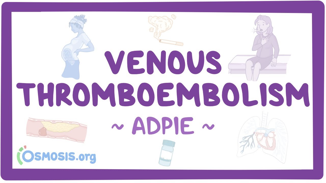 Venous thromboembolism (VTE): Nursing Process (ADPIE)