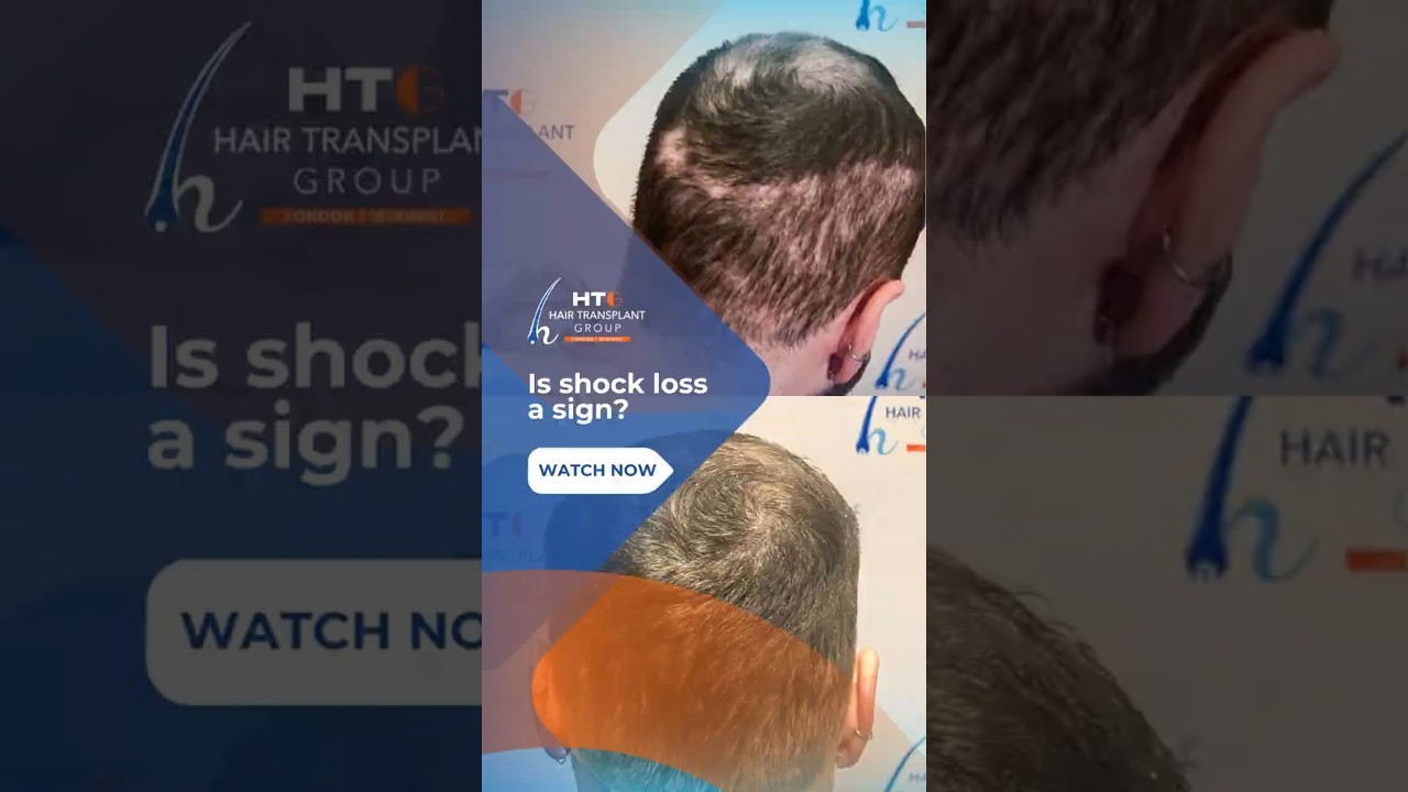 The Truth About Shock Loss – Why It’s NOT Hair Transplant Failure