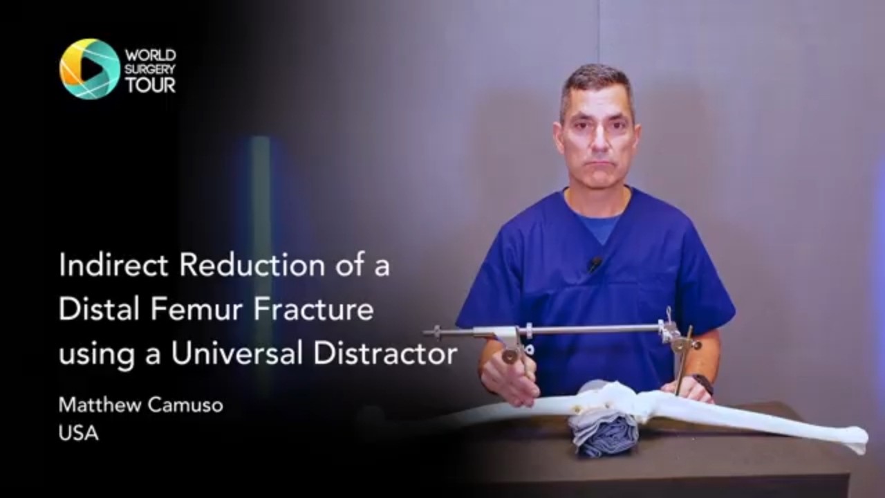 Indirect Reduction of a Distal Femur Fracture Using a Universal Distractor | Camuso #femurfracture