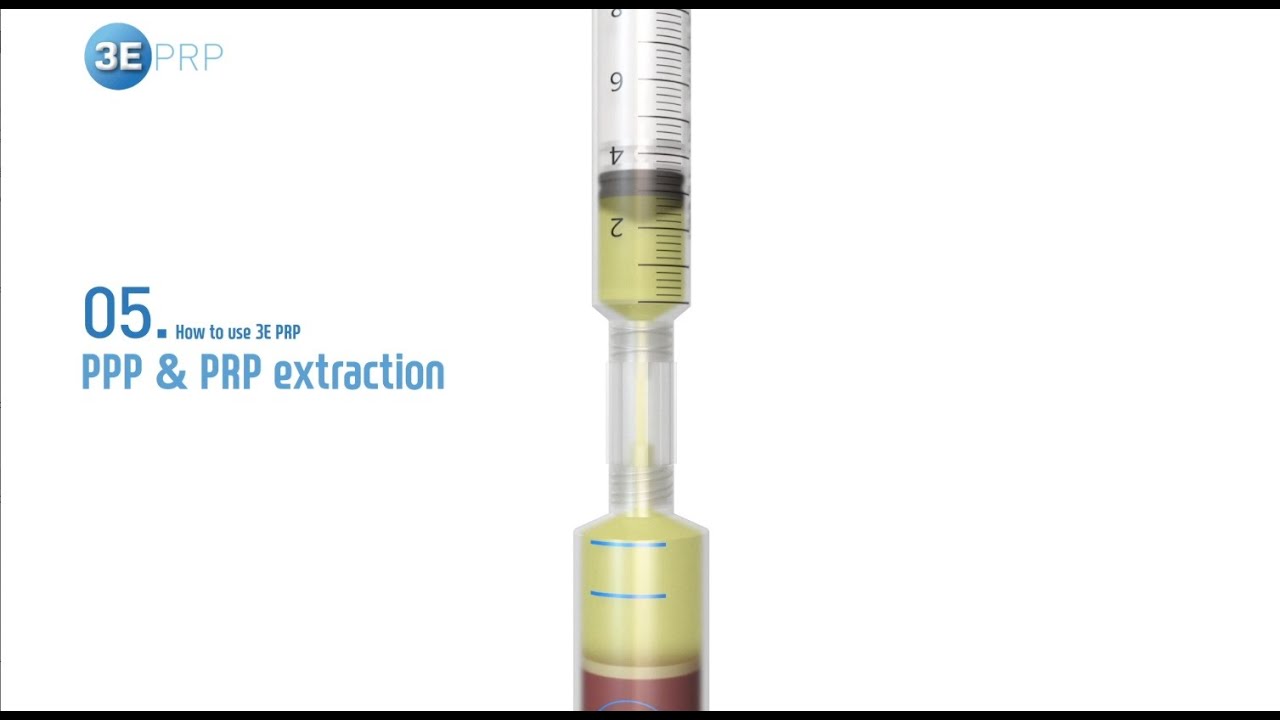 3E PRP - Platelet-rich plasma extraction guide