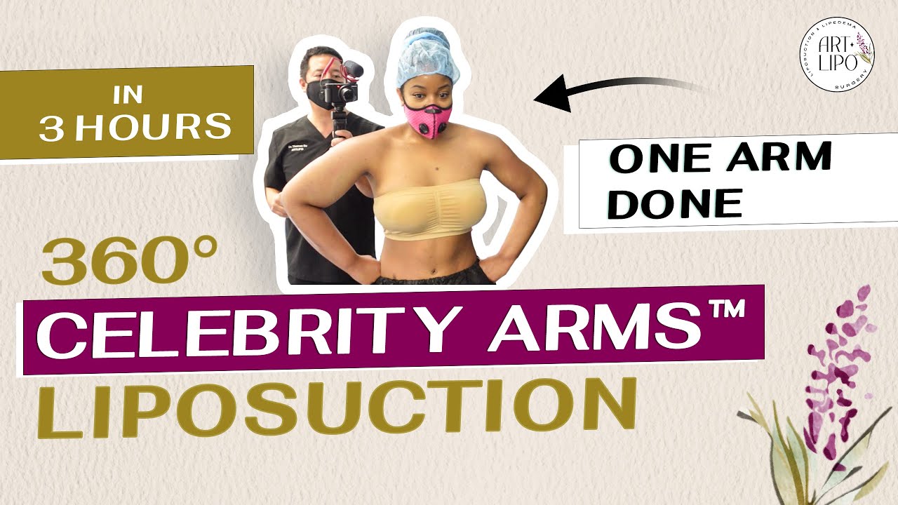 Celebrity Arms&trade; Liposuction | Immediate Results | Artlipo | Expert Dr. Thomas Su