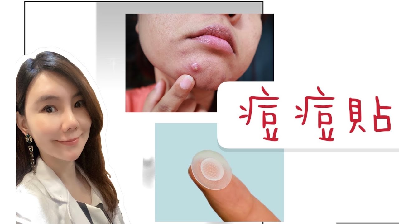 痘痘貼真不美觀？教妳正解使用的方法！
抗痘神器？ #痘痘貼 到底分哪幾類？ 甚麼情況適合貼痘痘貼？ 甚麼情況不適合貼？#使用痘痘貼的注意事項!(有cc字幕喔）