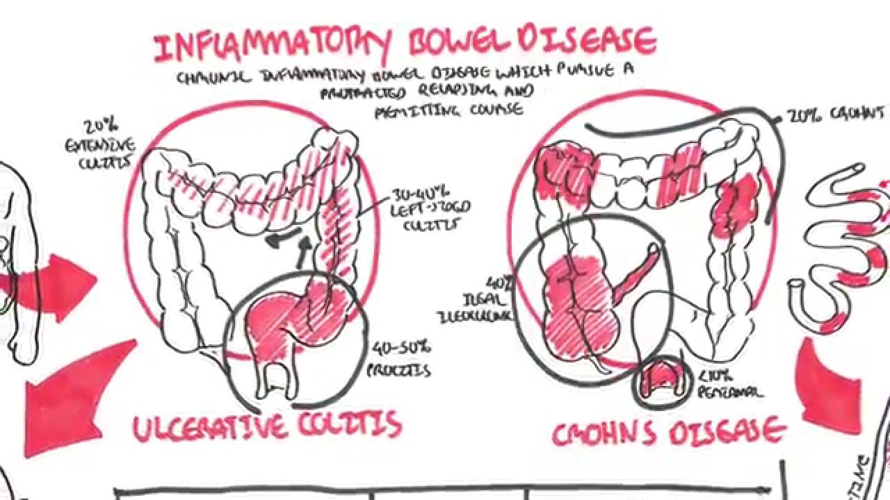 Inflammatory Bowel Disease (Overview, Crohn's and Ulcerative Colitis)