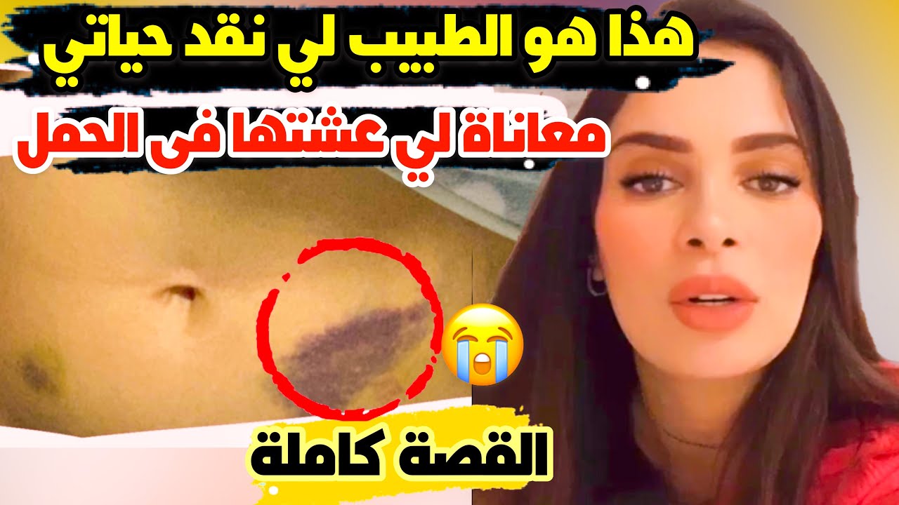 صفاء حبيركو : هادي هي معاناة لي عشتها فى الحمل و في الولادة القيصرية و هذا هو الطبيب لي نقد حياتي😪