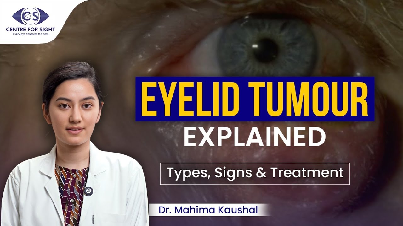 Eyelid Tumors Explained | Early Signs, Diagnosis & Treatment | Dr Mahima Kaushal
