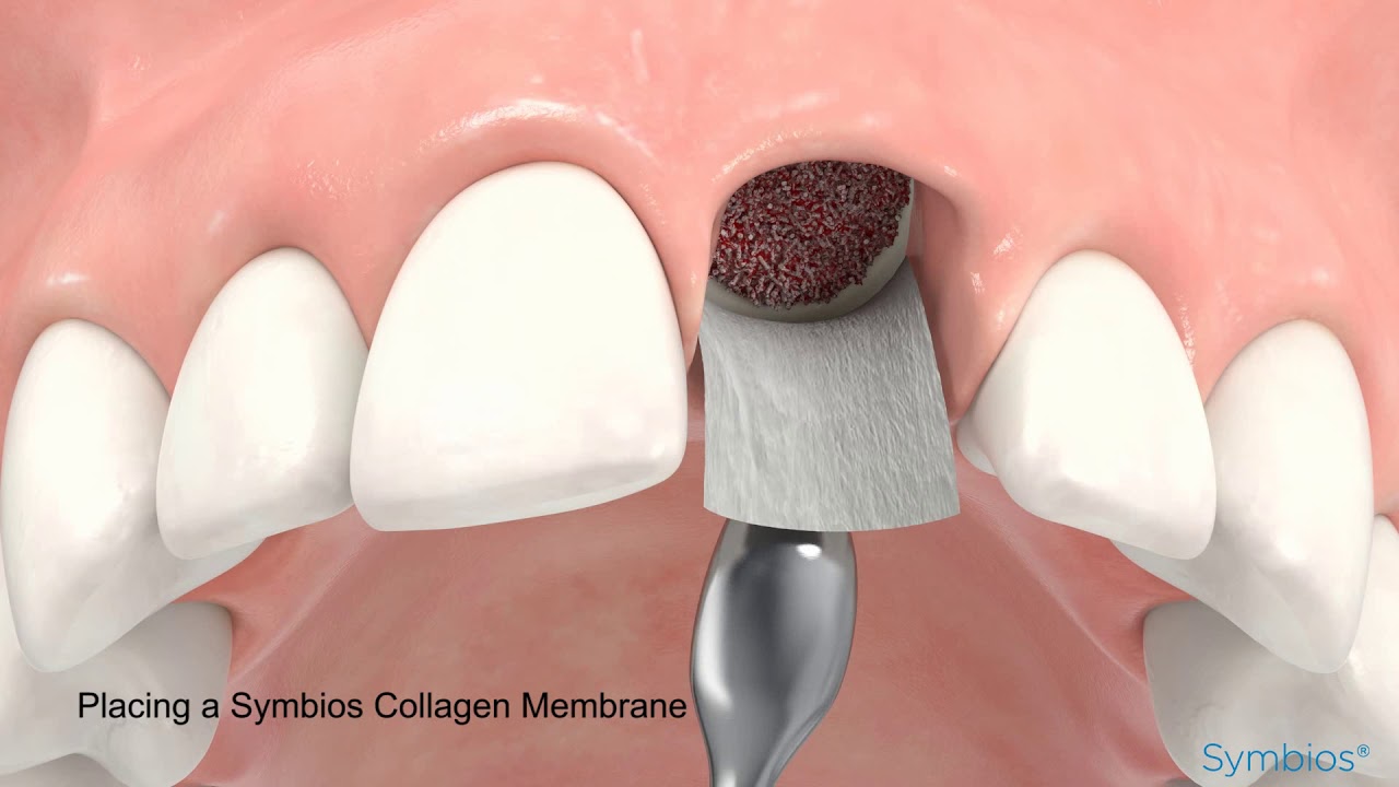 Symbios socket preservation for delayed implant loading