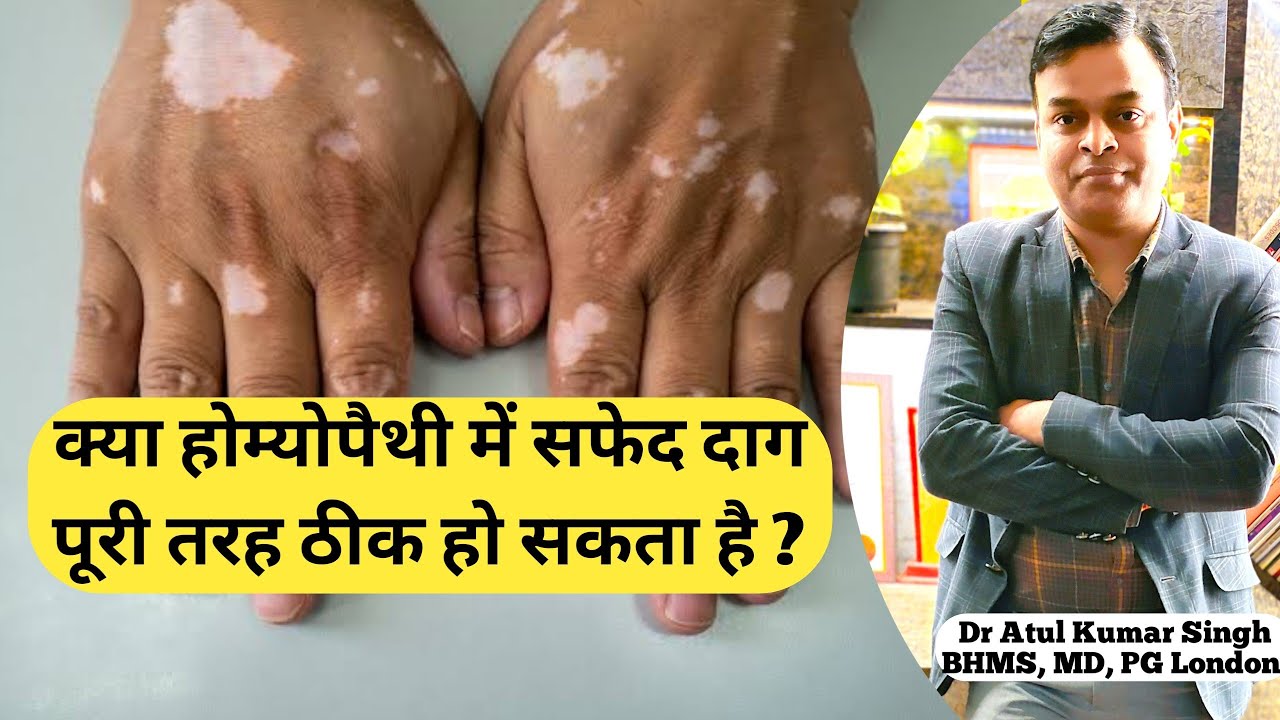 क्या सफेद दाग पूरी तरह से ठीक हो सकता है ? | Vitilago treatment | Leucoderma treatment | चरक का ईलाज