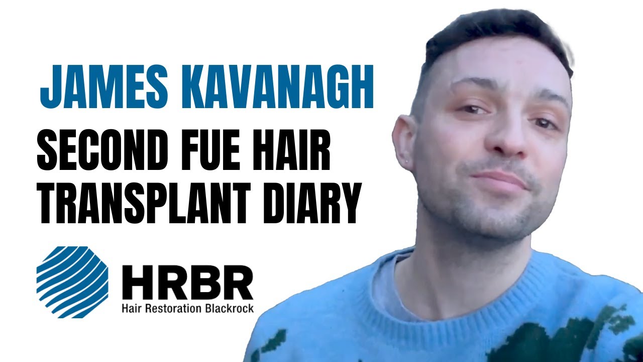 James Kavanagh Second FUE Hair Transplant Diary - Hair Restoration Blackrock