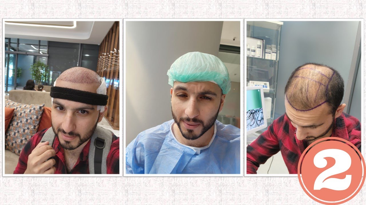 يوم العملية الأولى (زراعة الشعر في تركيا)