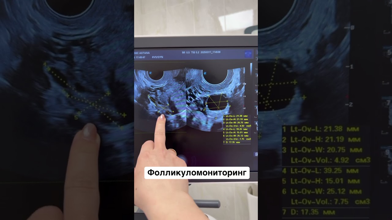 Фолликуломониторинг