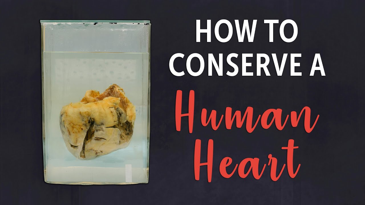 Our Newest Wet Specimen: A Giant Human Heart
